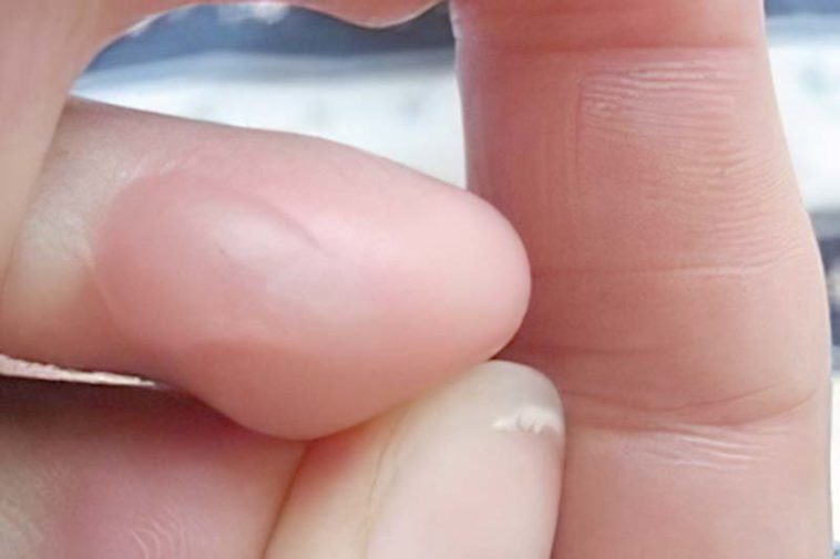 Bonne question Doiton percer des ampoules ou pas ? Astucesbox