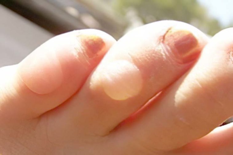 Bonne question Doiton percer des ampoules ou pas ? Astucesbox